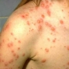 68 заболели от варицела само за седмица в Бургас 