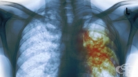 СЗО: Най-страшната инфекциозна болест в света е туберкулозата