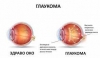 Над 500 пенсионери се възползваха от профилактичните прегледи за глаукома