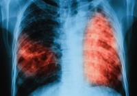 Безплатни прегледи за туберкулоза в цялата страна и Бургас